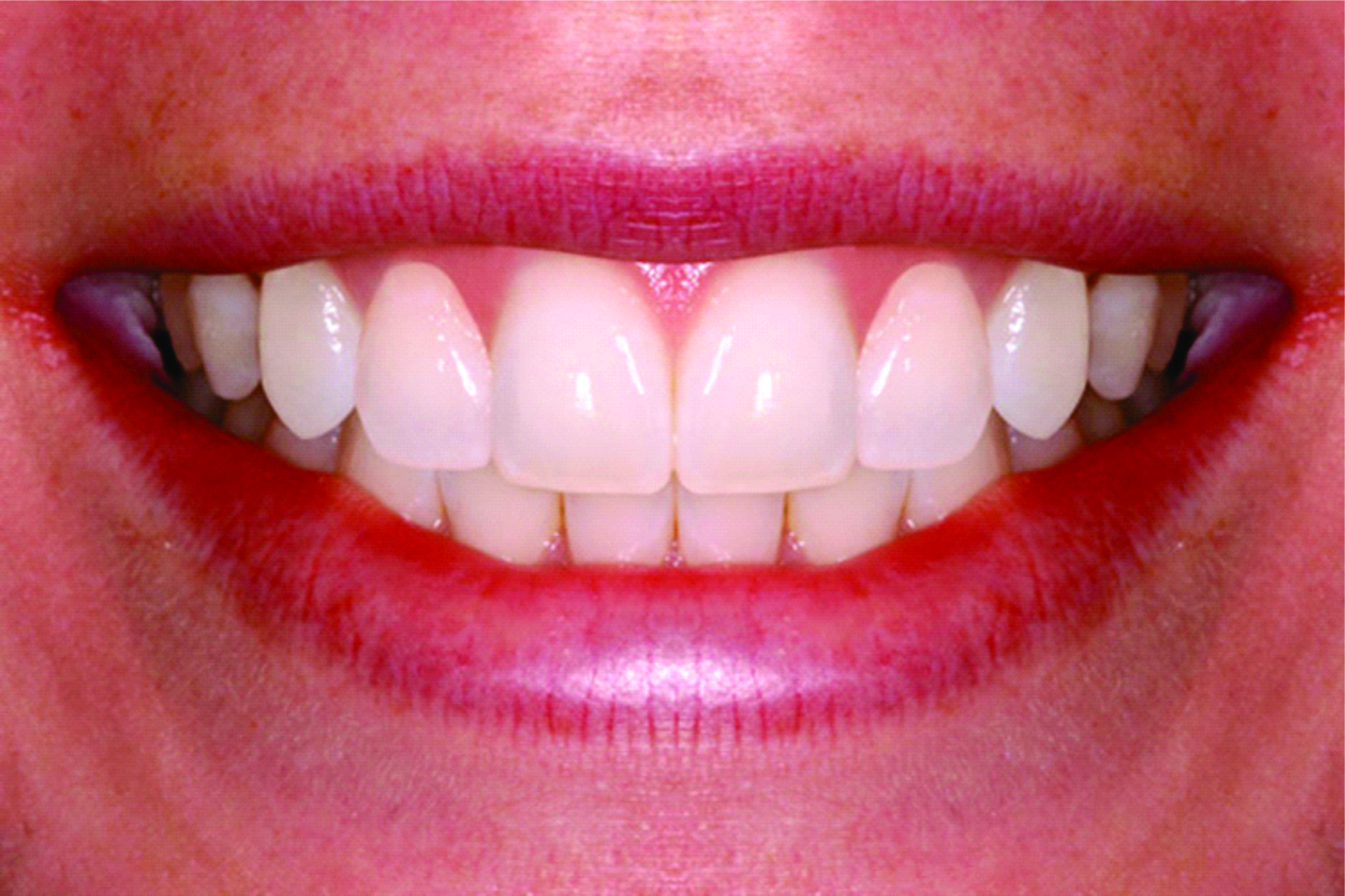 Клык сверху зубов. Идеальные зубы. Идеальная форма зубов. Красивая форма зубов. Идеальная форма передних зубов.